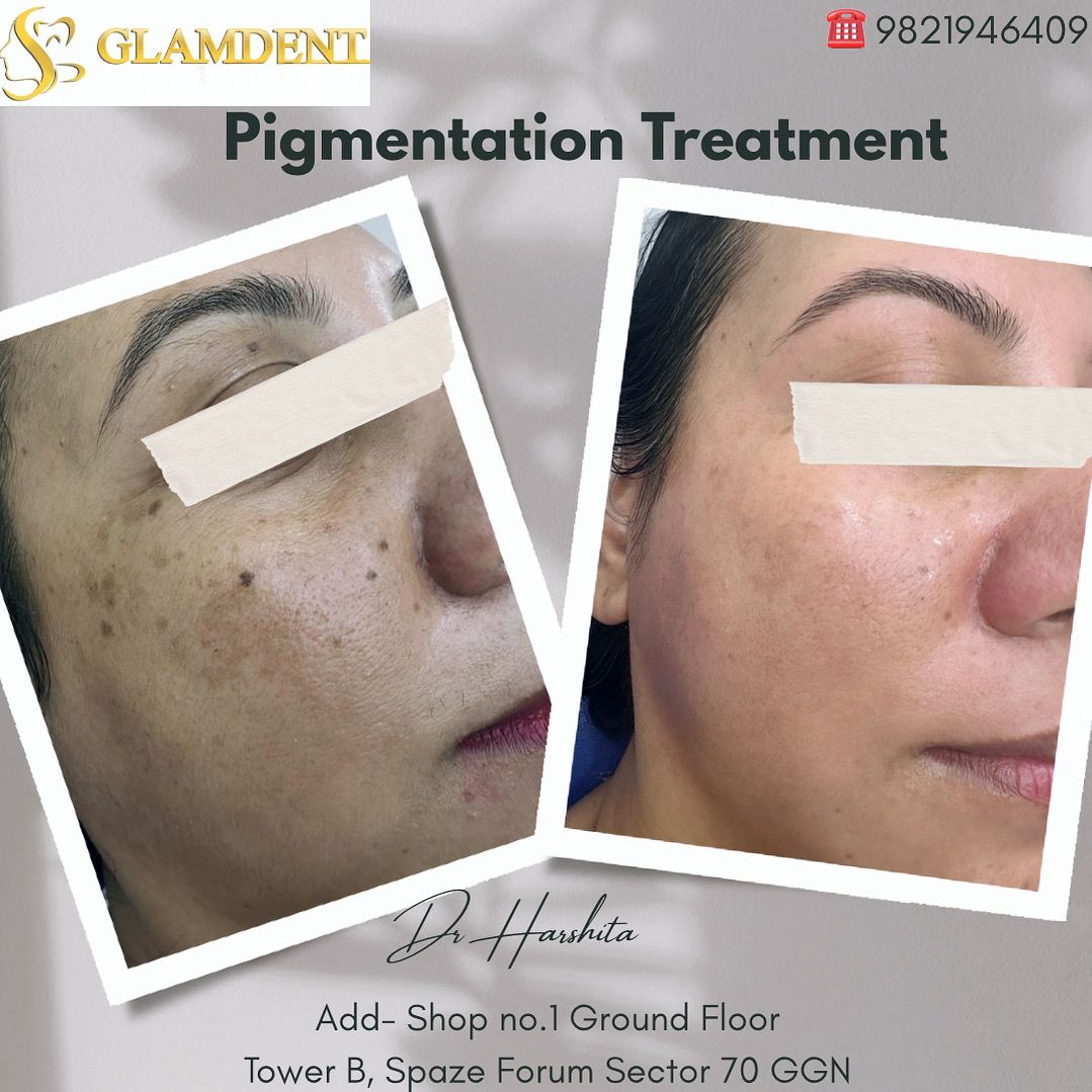 Treatment Picutres