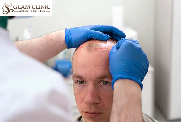 PRP,  GFC, Mesotherapy Hair Treatment