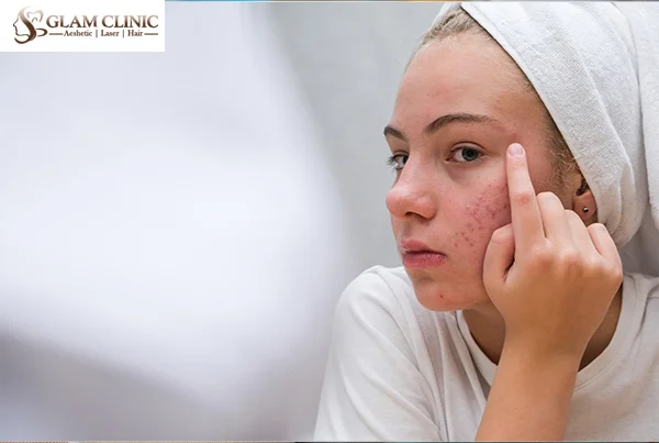 Acne and Scar