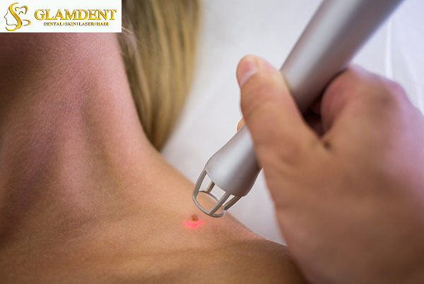 Skin Tags, Mole And Wart Removal