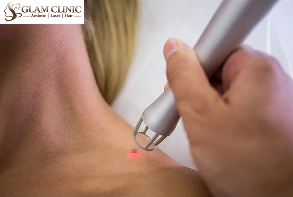 Skin Tags, Mole And Wart Removal