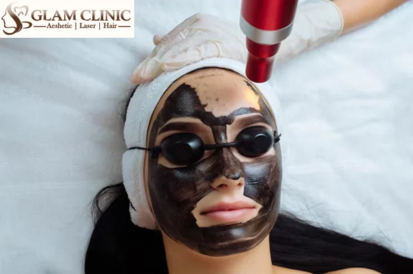 Carbon Laser Peel