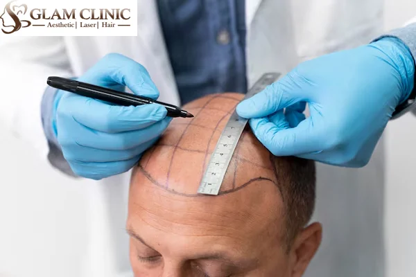 Hair Transplant Surgery